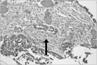 Figure 3: Nerve-Infiltration