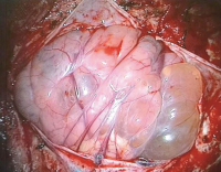 Figure 4: Brain-Collision-Tumour