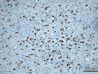 Figure 5: Brain-Collision-Tumour