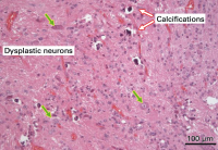 Figure 6: Brain-Collision-Tumour