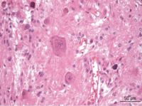Figure 7: Brain-Collision-Tumour