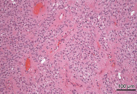 Figure 8: Brain-Collision-Tumour