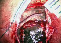Figure 1: Leptomeningeal Tumour