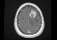 Figure 2: Leptomeningeal Tumour