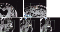 Figure 1-b: Radiotherapy - Meningioma