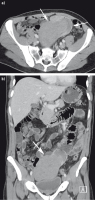 Abbildung 1a-b: Dnndarm - Tumor