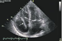 Figure 1: Transthoracic echocardiogram