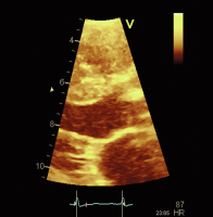 Abbildung 3: LVOT