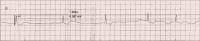 Abbildung 1: Bradyarrhythmie