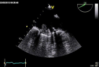 Abbildung 5: TEE - Thrombus