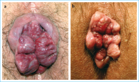 Abbildung 1a-b: Hmorrhoiden