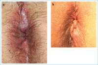 Abbildung 2a-b: Hmorrhoiden