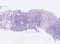 Abbildung 4a: Follikulres Lymphom
