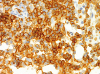 Abbildung 4c: Follikulres Lymphom