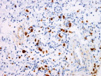 Abbildung 4d: Follikulres Lymphom