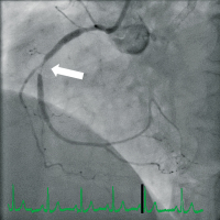 Abbildung 5: In-Stent-Restenose