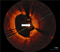Abbildung 9: Thrombus - In-Stent-Restenose