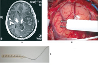 Figure 3A-C: Awake Craniotomy