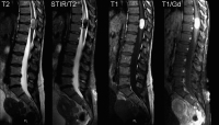 Figure 1: Spinal Teratoma