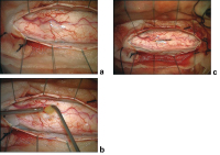 Figure 2a-c: Spinal Teratoma