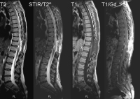 Figure 3: Spinal Teratoma