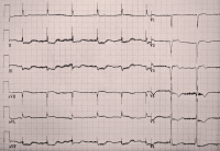 Abbildung 1: EKG-Beispiel
