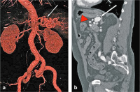 Abbildung 3a-b: Sacciformes Aneurysma