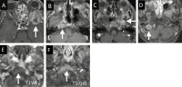 Figure 1a-f: Skull-base metastases