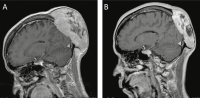 Figure 2a-b: Calvarial metastasis