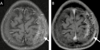 Figure 4a-b: Calvarial metastasis