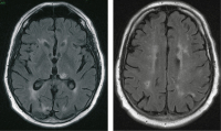 Figure 1a-b: Brain-Lymphoma