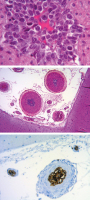 Figure 2a-c: Brain-Lymphoma