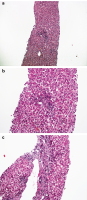 Abbildung 3a-c: Hepatitis-C-Rekurrenz