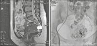 Abbildung 2a-b: Uterus myomatosus 