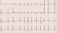 Abbildung 1: EKG