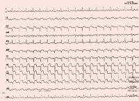 Abbildung 1: EKG