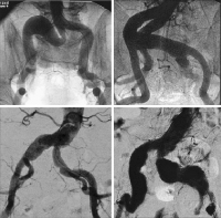 Abbildung 1: Isoliertes Iliakalaneurysma