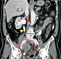 Abbildung 3: Iliakalaneurysma