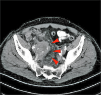 Abbildung 4: Iliakalaneurysma