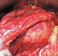 Abbildung 6: Isoliertes Iliakalaneurysma