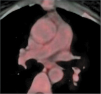 Abbildung 4: PET-CT
