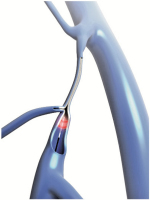 Abbildung 1: Produkt: ELVeS Radial-Lasertherapie<br>Vertrieb: biolitec AG