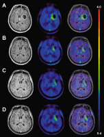 Figure 1a-d: Glioblastoma