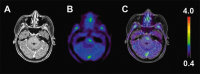 Figure 2a-c: Distant Tumour