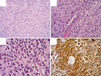 Figure 2a-d: Tumoral proliferation