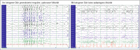 Abbildung 2: EEG - Ketogene Dit