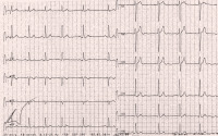 Abbildung 1: Ruhe-EKG