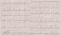 Abbildung 5: Ruhe-EKG