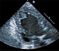 Abbildung 1: Thrombus