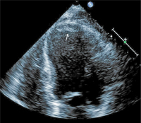 Abbildung 2: Thrombus